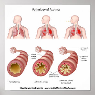 Lungenerkrankung Asthma Poster