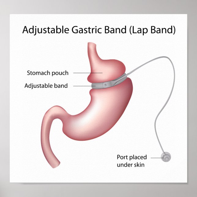 Magenband Gewichtsverlust Operation Poster (Vorne)