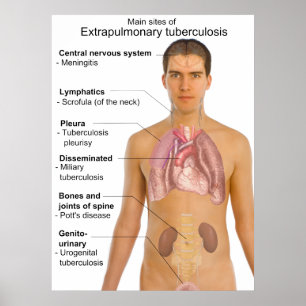 Main Symptoms of Extrapulmonary Tuberculosis Chart Poster