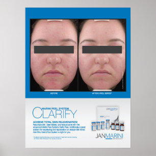 Marini Peel verdeutlicht Ergebnisse 18x24" Poster