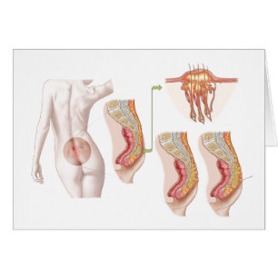 Medizinische Ilustration einer Pilonidalzyste