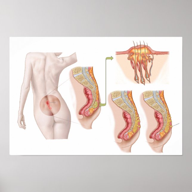 Medizinische Ilustration einer Pilonidalzyste Poster (Vorne)