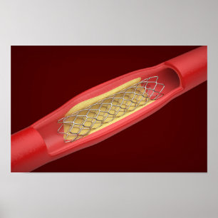 Medizinischer Stent in einem Blutgefäß Poster