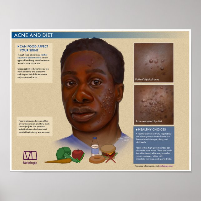 Melalogic Akne and Diet Medical Poster (Vorne)