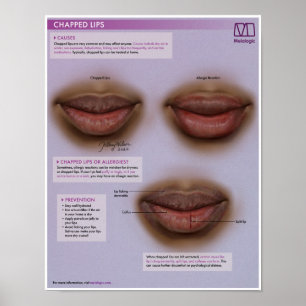 Melalogic Chapped Lips Medical Poster