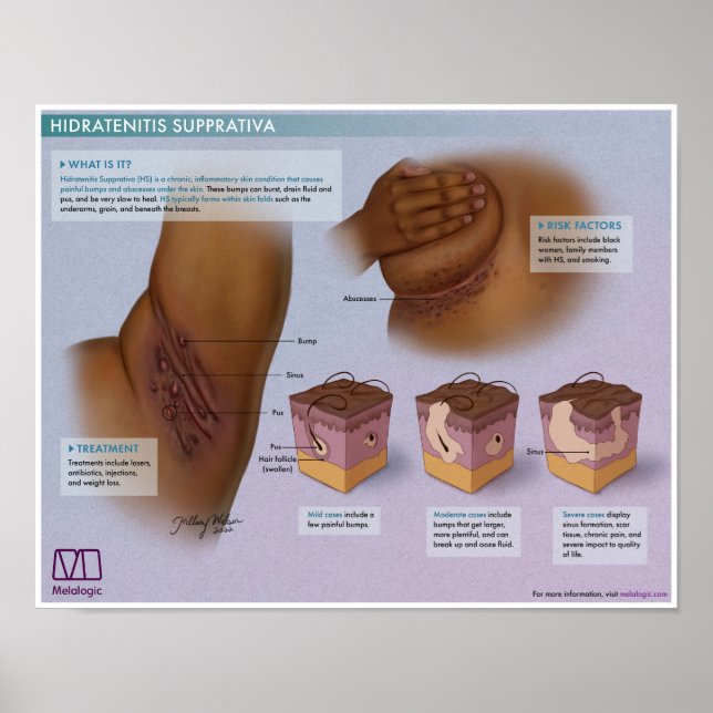 Melalogic Hidradenitis Supprativa Medical Poster (Vorne)