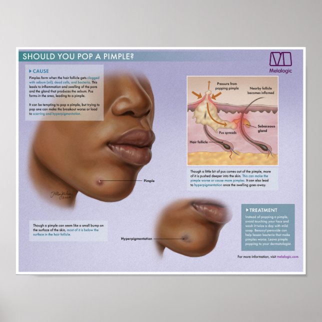 Melalogic Popping Pimples Medical Poster (Vorne)