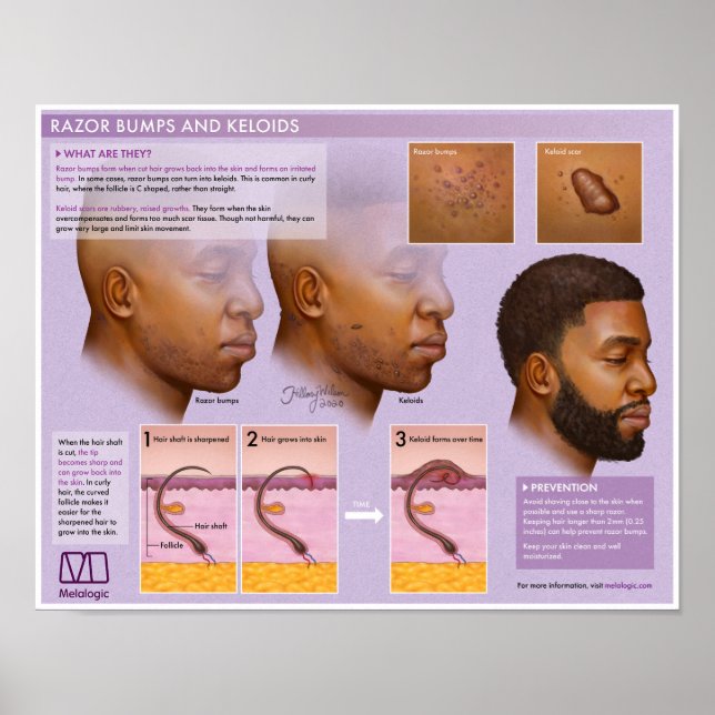 Melalogic Razor Bumps and Keloids Medical Poster (Vorne)