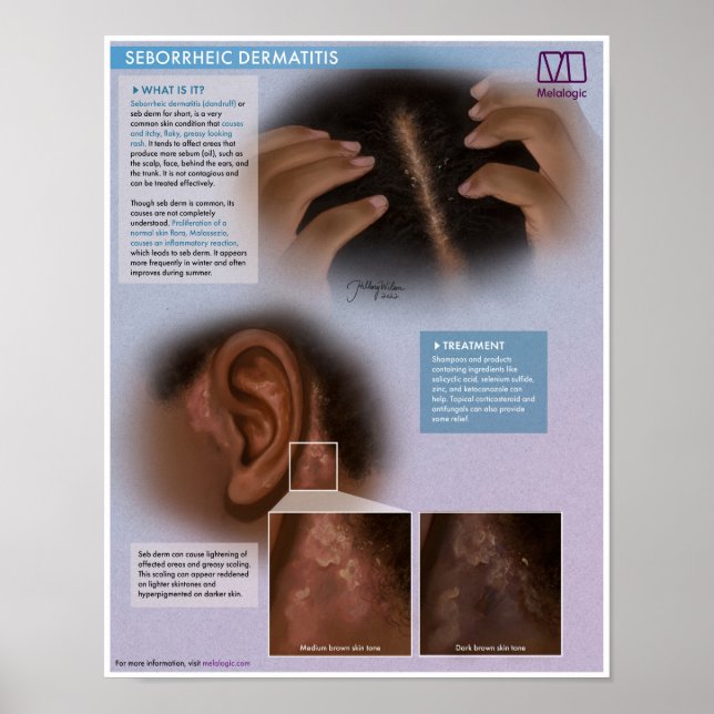 Melalogic Seborrheic Dermatitis (Dandruff) Medical Poster (Vorne)