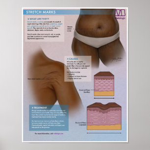 Melalogic Stretch Markus Medical Poster