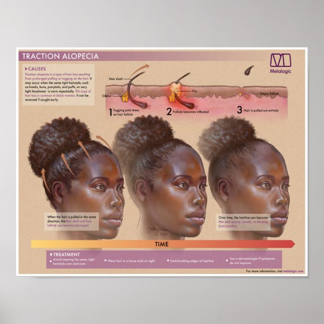Melalogic Traction Alopezie Medikales Poster (Vorne)