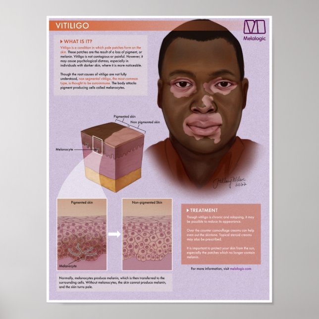 Melalogic Vitiligo Medical Poster (Vorne)