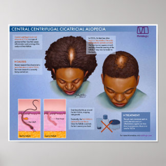 Melalogic zentrifugal Cicatricial Alopezie Poster