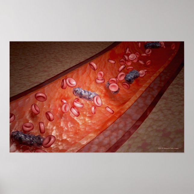 Mikroskopische Darstellung einer Blutinfektion Poster (Vorne)