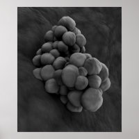 Mikroskopische Darstellung von Tumor 1
