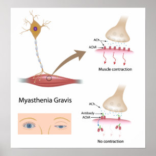 Myasthenie Gravis eye Poster