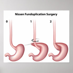 Nissen Fundoplication stomer Operation Poster