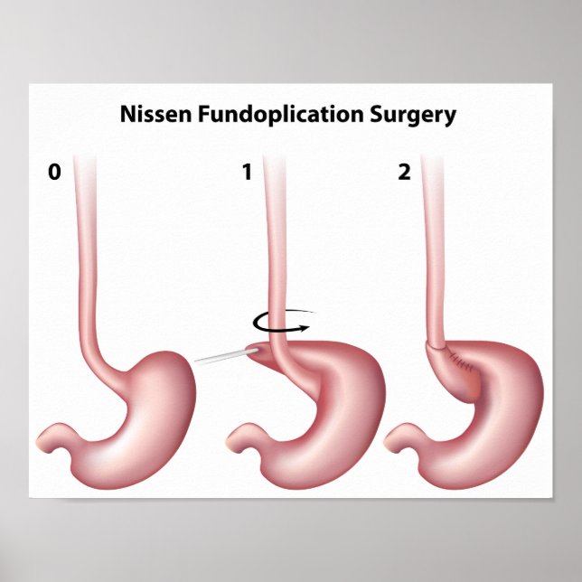 Nissen Fundoplication stomer Operation Poster (Vorne)