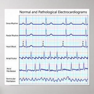 Normale und pathologische eca Poster