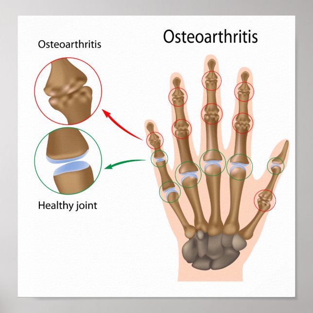 Osteoarthritis der Hand Poster (Vorne)