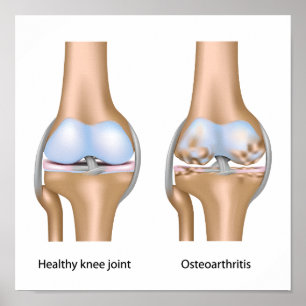 Osteoarthritis Kniegelenk-Poster Poster