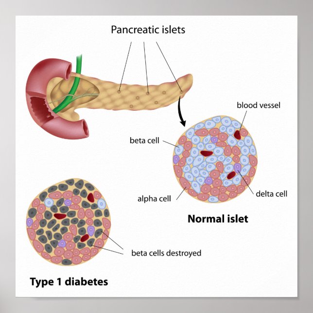 Pankreasinsel und Diabetes Poster (Vorne)