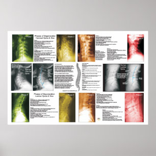 Phasen Zervikales Lumbar Spinal Degenerations Post Poster