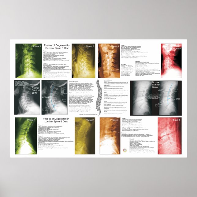 Phasen Zervikales Lumbar Spinal Degenerations Post Poster (Vorne)