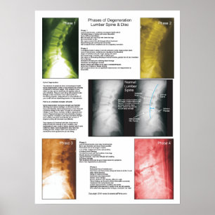 Phases Lumbar Spinal Degenerations Poster
