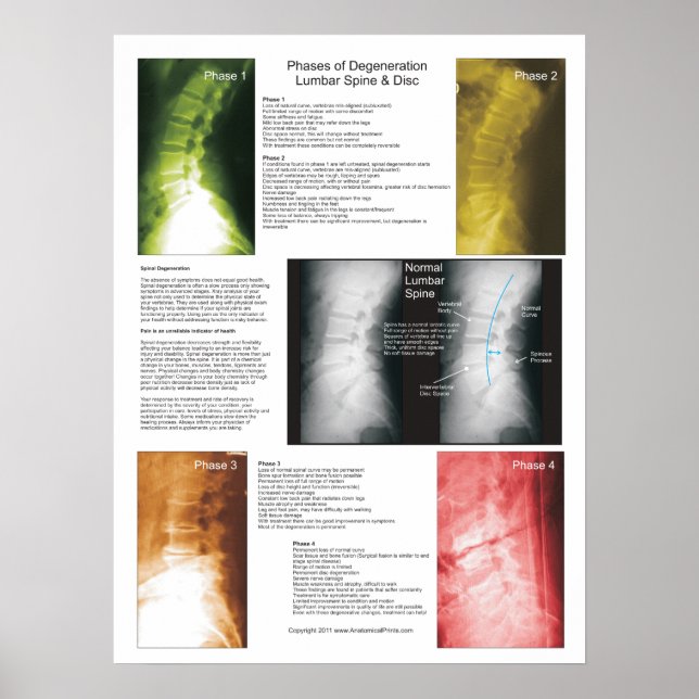 Phases Lumbar Spinal Degenerations Poster (Vorne)