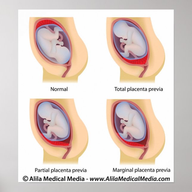 Placenta previa poster (Vorne)