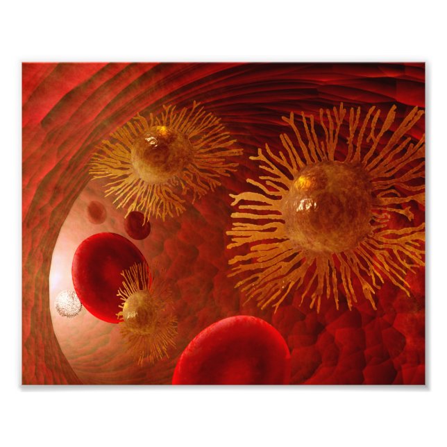 Plakat zur Krebsmetastasierung Fotodruck (Vorne)