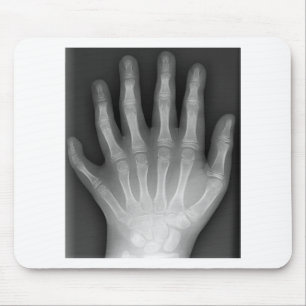 Polydaktylie, sechs fingrige Hand, Röntgenstrahl, Mousepad