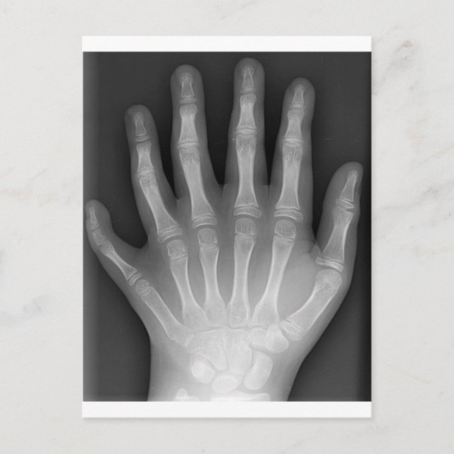 Polydaktylie, Sechs gefederte Hand, X-Ray, Seltenh Postkarte (Vorderseite)
