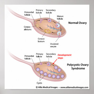 Polyzystisches Ovarialsyndrom, beschriftet. Poster
