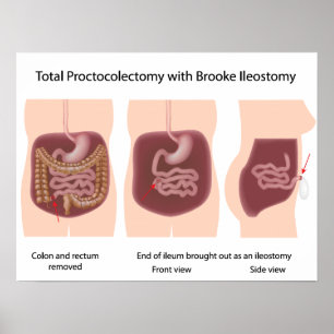 Proktoktomie insgesamt mit Brooke-Ileostomy-Poster Poster