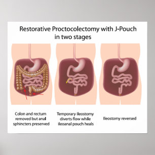 Restorative Proktoktomie mit j-pouch 2 Bühnen Poster