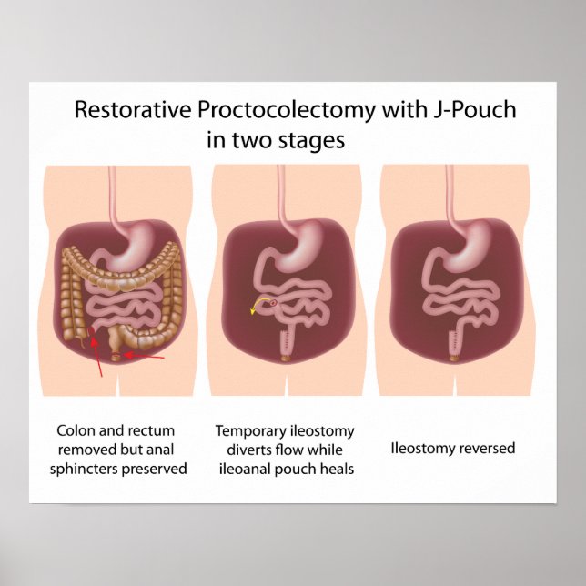 Restorative Proktoktomie mit j-pouch 2 Bühnen Poster (Vorne)