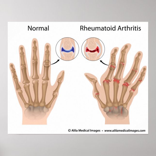 Rheumatoide Arthritis der Fingergelenke, Diagramm. Poster (Vorne)