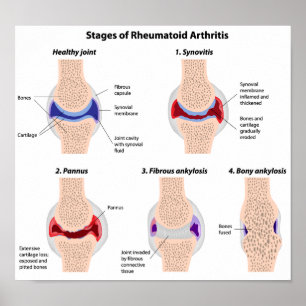 Rheumatoide Arthritis Poster