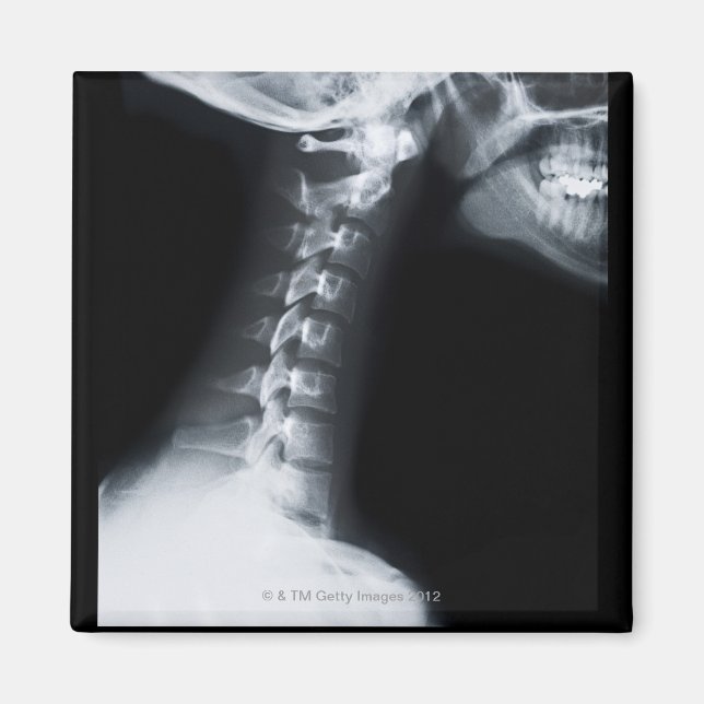 Röntgenaufnahme der Halswirbel einschließlich Unte Magnet (Vorne)