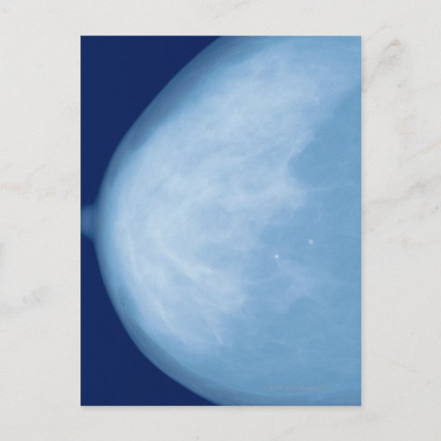 Röntgenaufnahme der weiblichen Brust, Seitenansich Postkarte (Vorderseite)