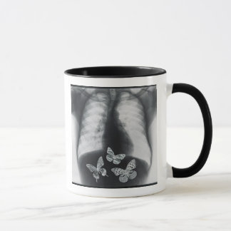 Röntgenstrahl der Schmetterlinge im Magen Tasse