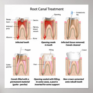 Root Canal Behandlung Poster
