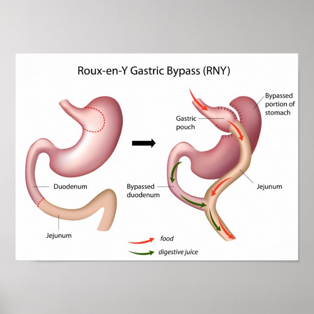 Roux-en-Y Gastric Bypass Operation Poster (Vorne)