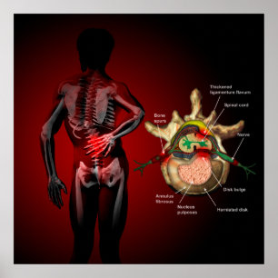 Rückenschmerzen Poster