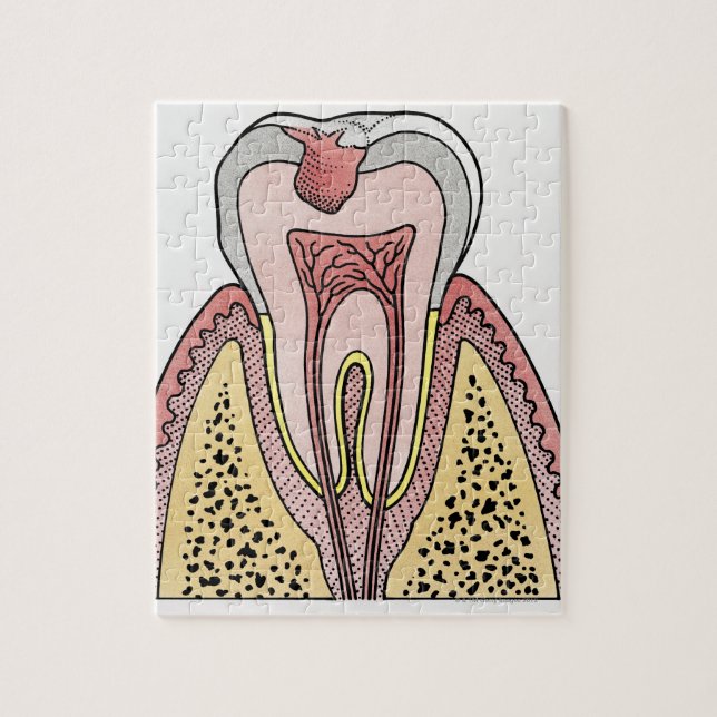 Schnittbild mit Zahnextraktion Puzzle (Vertikal)