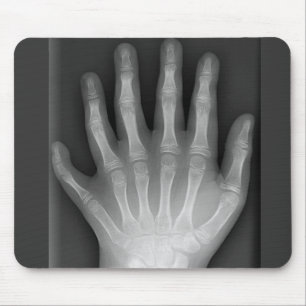 Sechs fingrige Hand, medizinische Rarität, Mousepad