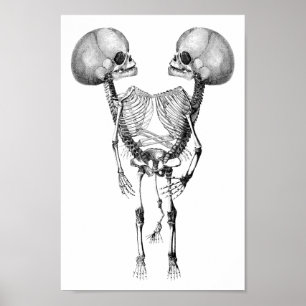 Siamesisch verbunden Twins Anatomie Skeletton Kuns Poster