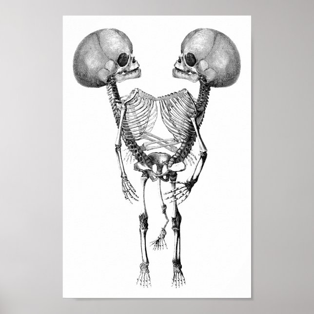 Siamesisch verbunden Twins Anatomie Skeletton Kuns Poster (Vorne)